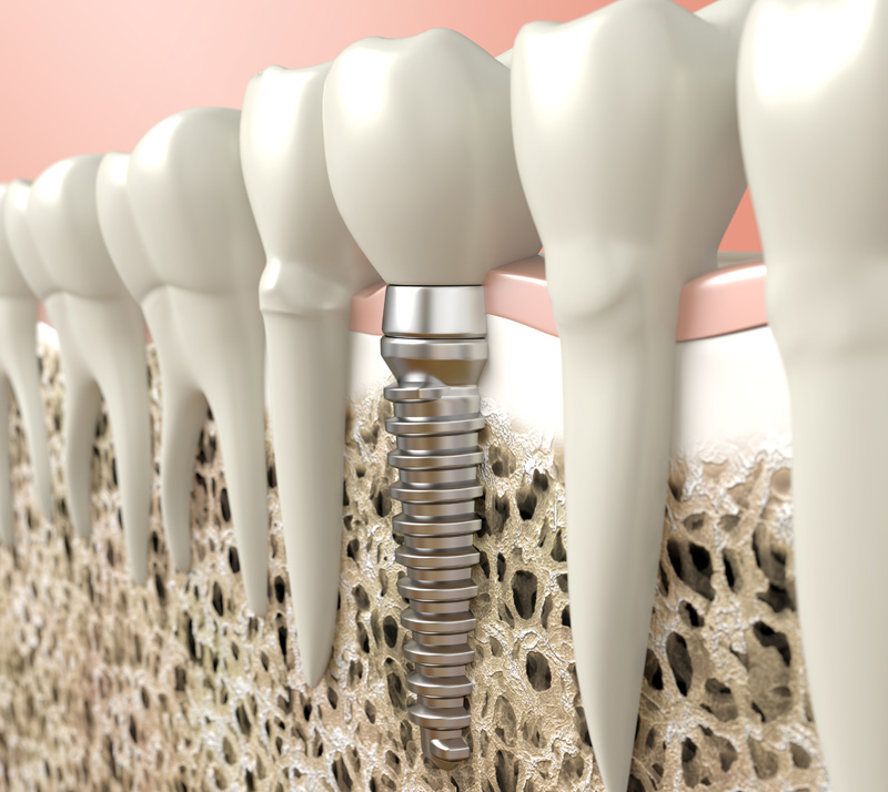 dental implants in red deer