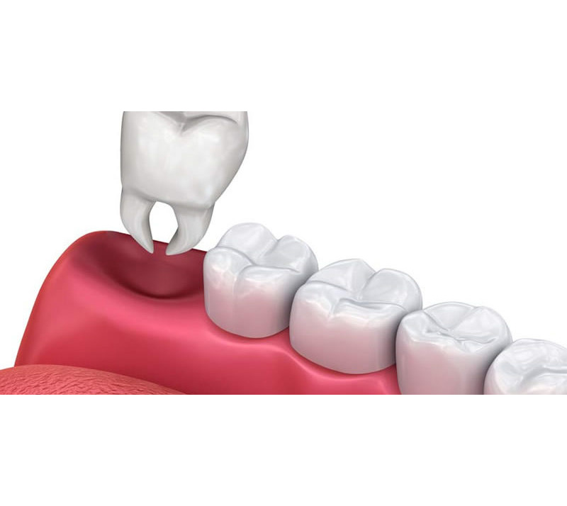 teeth extractions in red deer