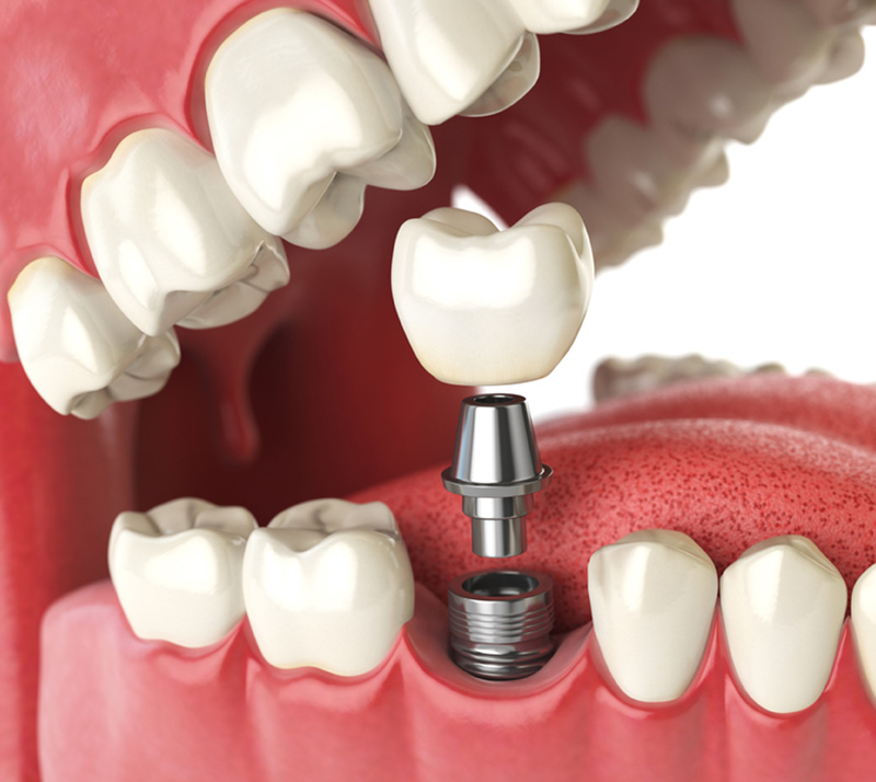 Dental-Implants-2 Dr. Peter Servinis