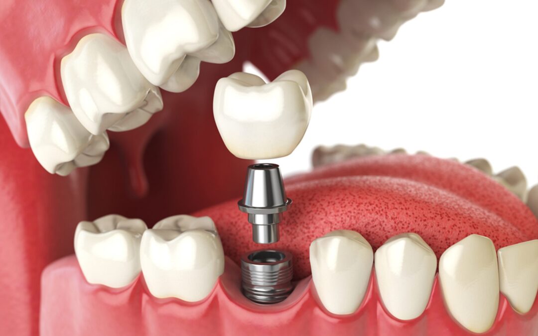 all you need to know about the dental implant process in canada