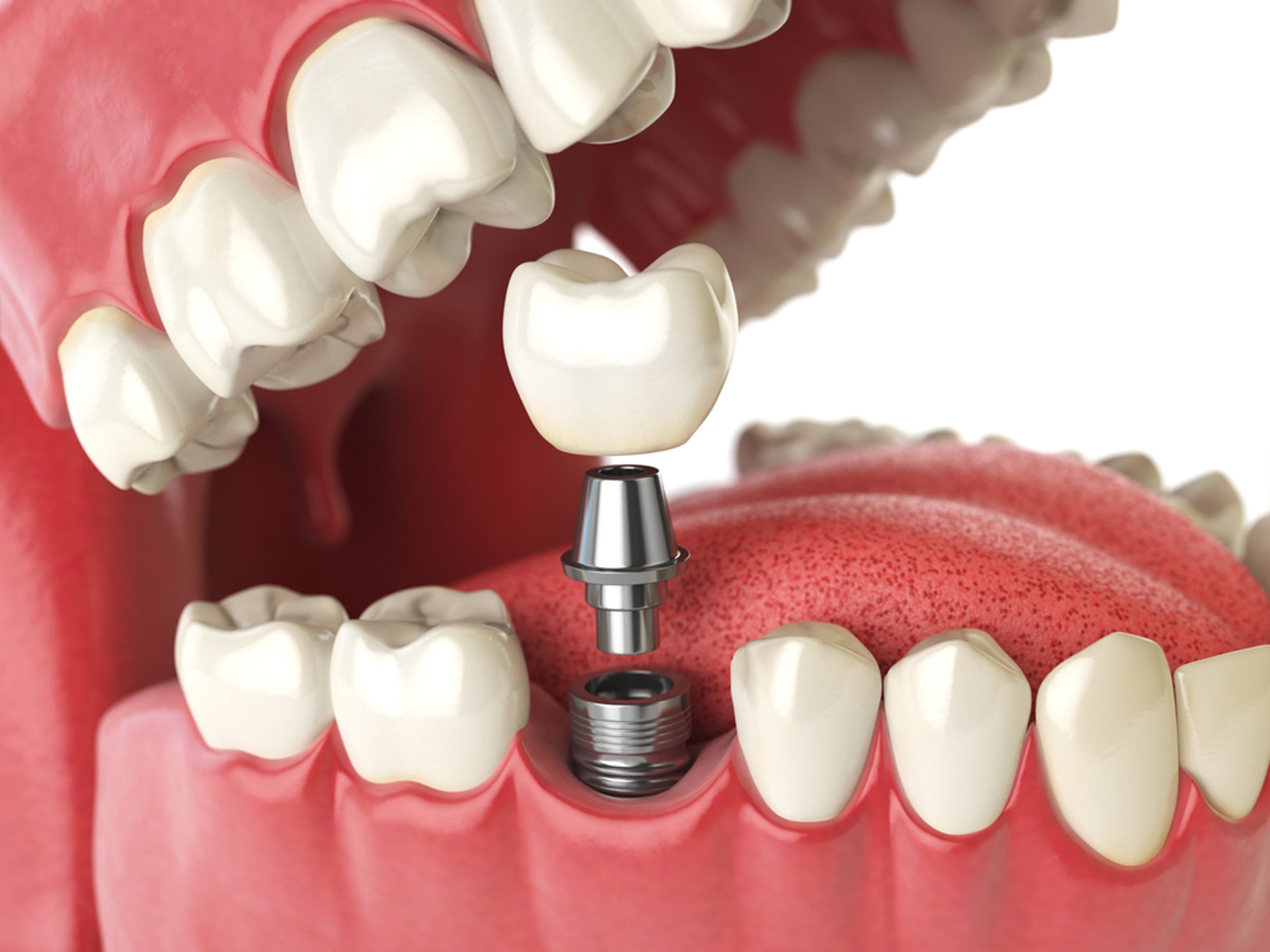 All You Need to Know about the Dental Implant Process in Canada