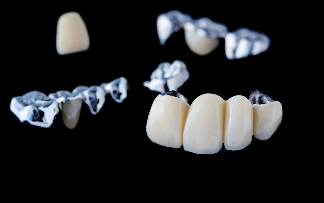 Dental bridges in Red Deer